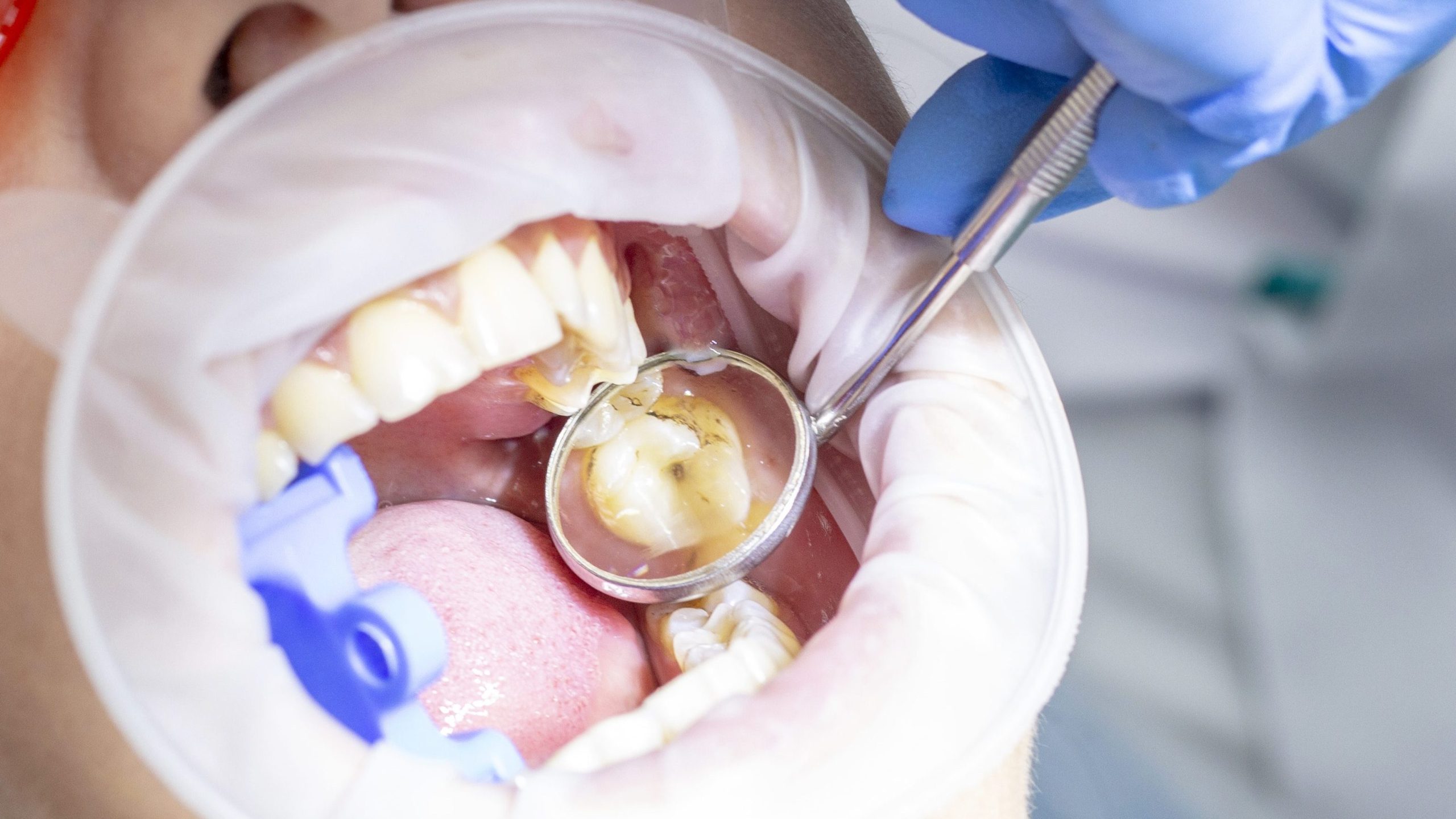 girl at the reception at the dentist. treatment of carious tooth. on top of your teeth caries